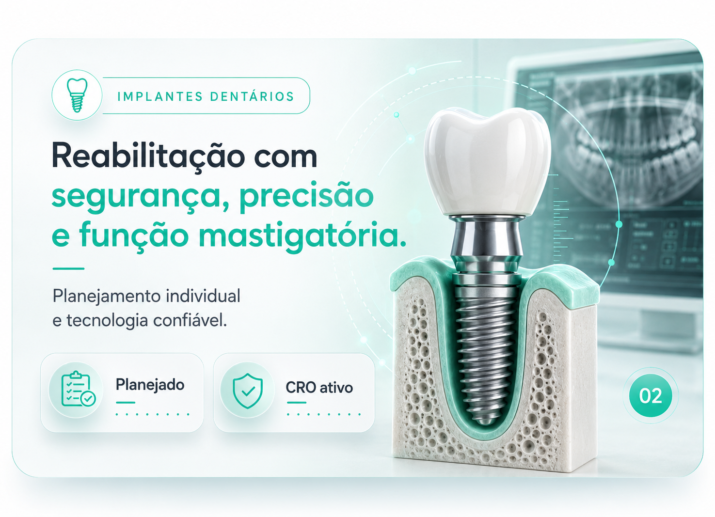 Implantes Dentários